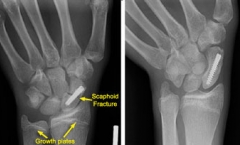 Researching scaphoid pin location